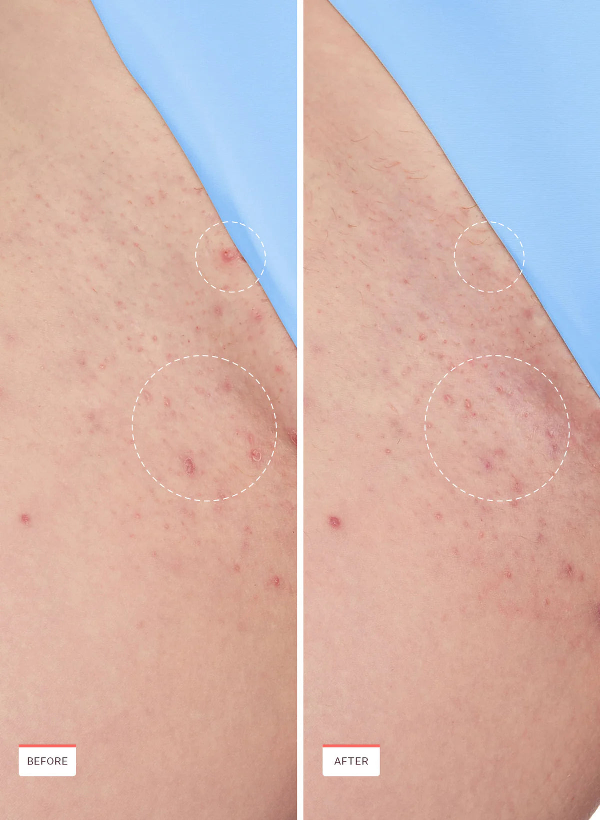 Alvada SmoothFix™ – Anti-Ingrown Elixir
