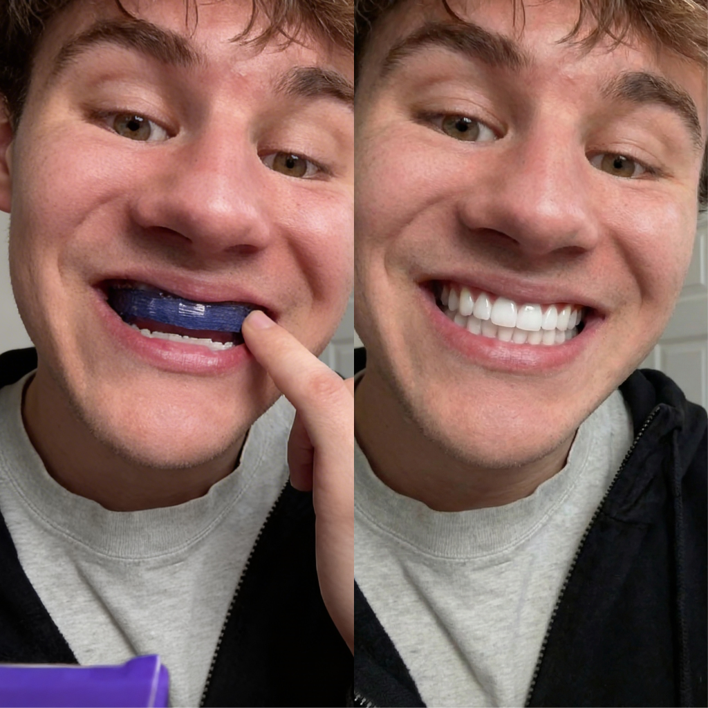 Purple Whitening Strips