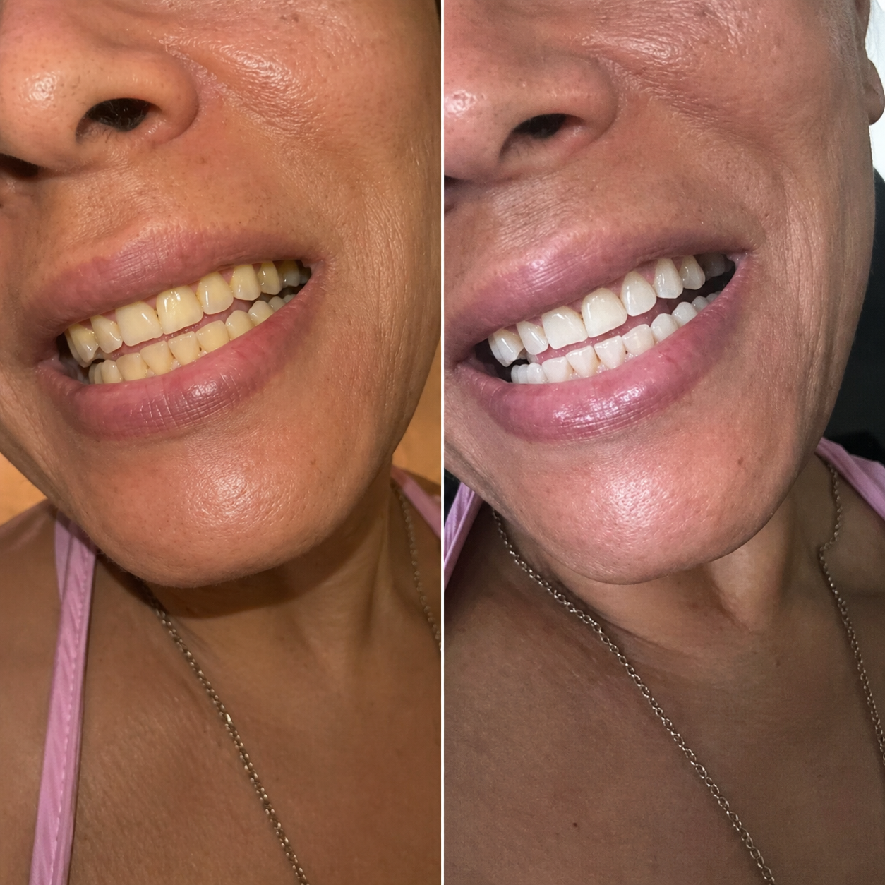 Kokosnuss Whitening Strips