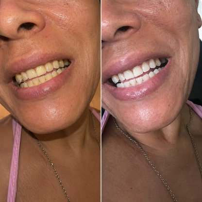 Kokosnuss Whitening Strips